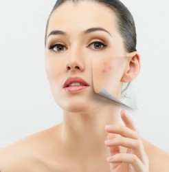 5 Ways to Reduce Acne Scars - Mom it ForwardMom it Forward